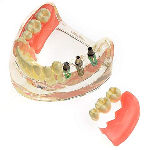 Modelo odontológico Contraste Restauração de implantes para os dentes molares ausentes M-6006